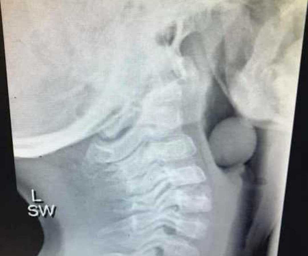 xray of grape lodged in airway