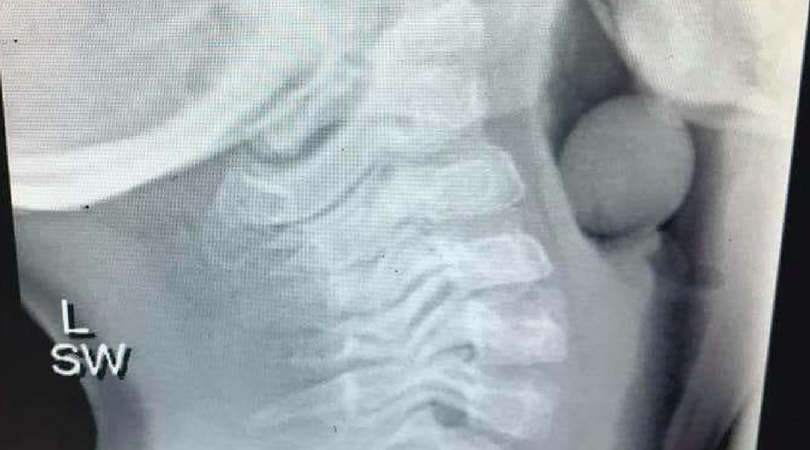 xray of grape lodged in airway