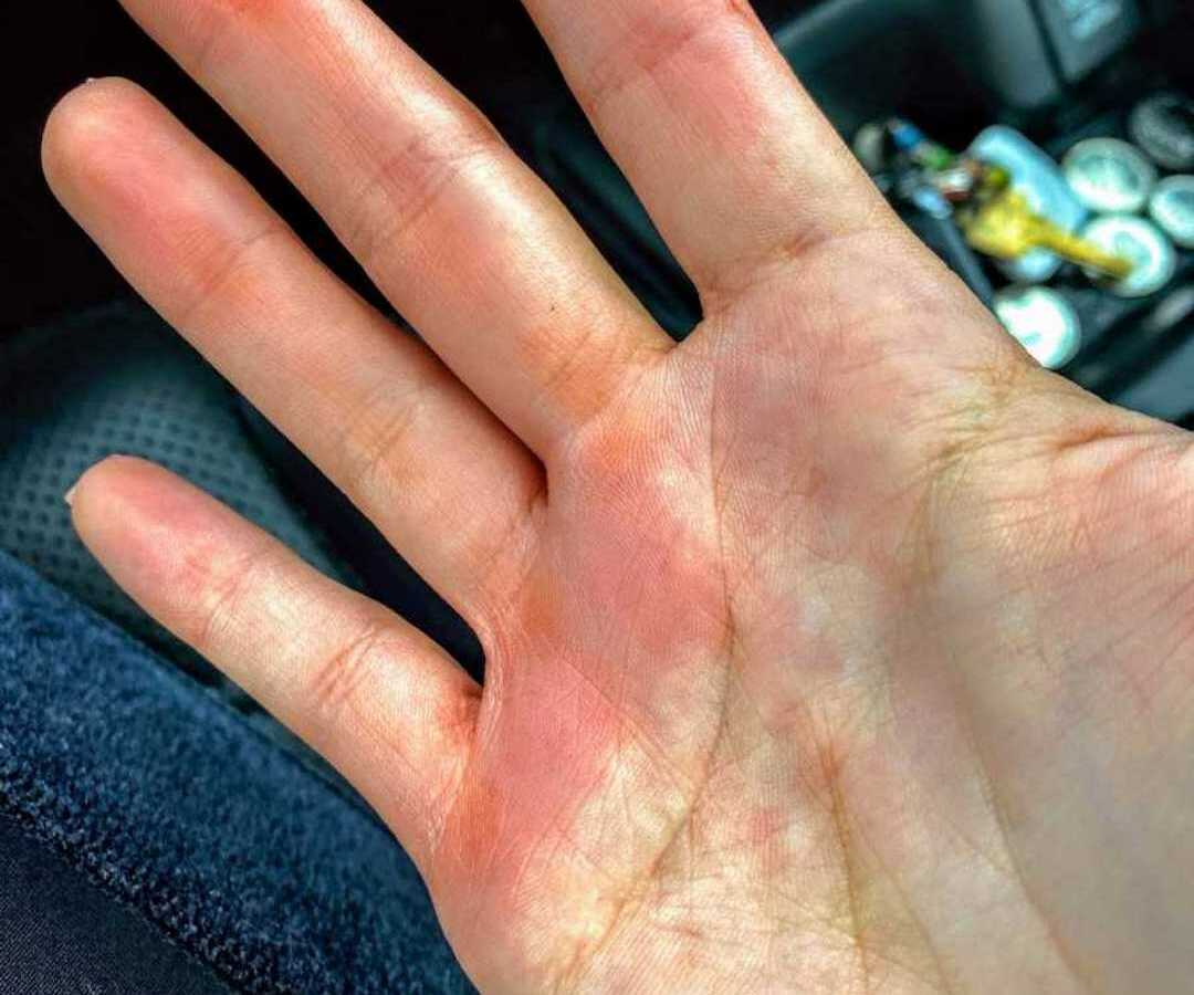 hand red from gripping steering wheel