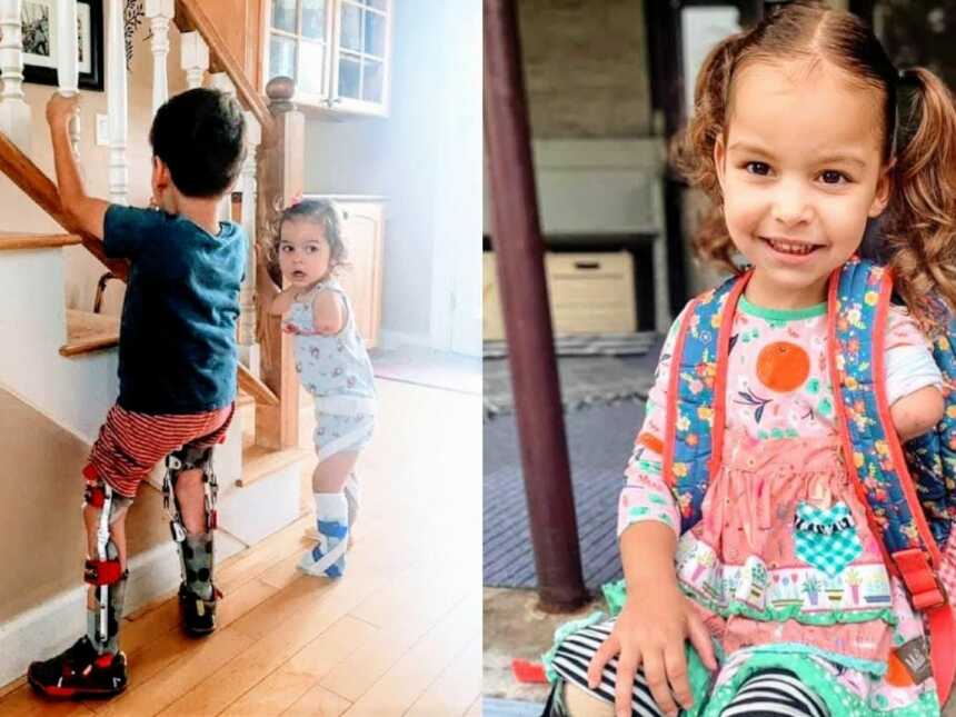 young girl with limb difference