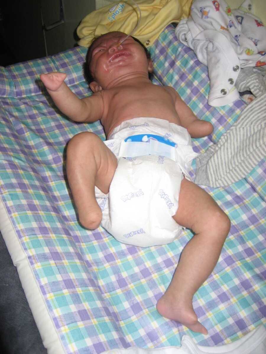 Newborn baby with limb difference crying