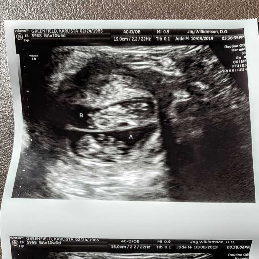 Ultrasound of twin girls